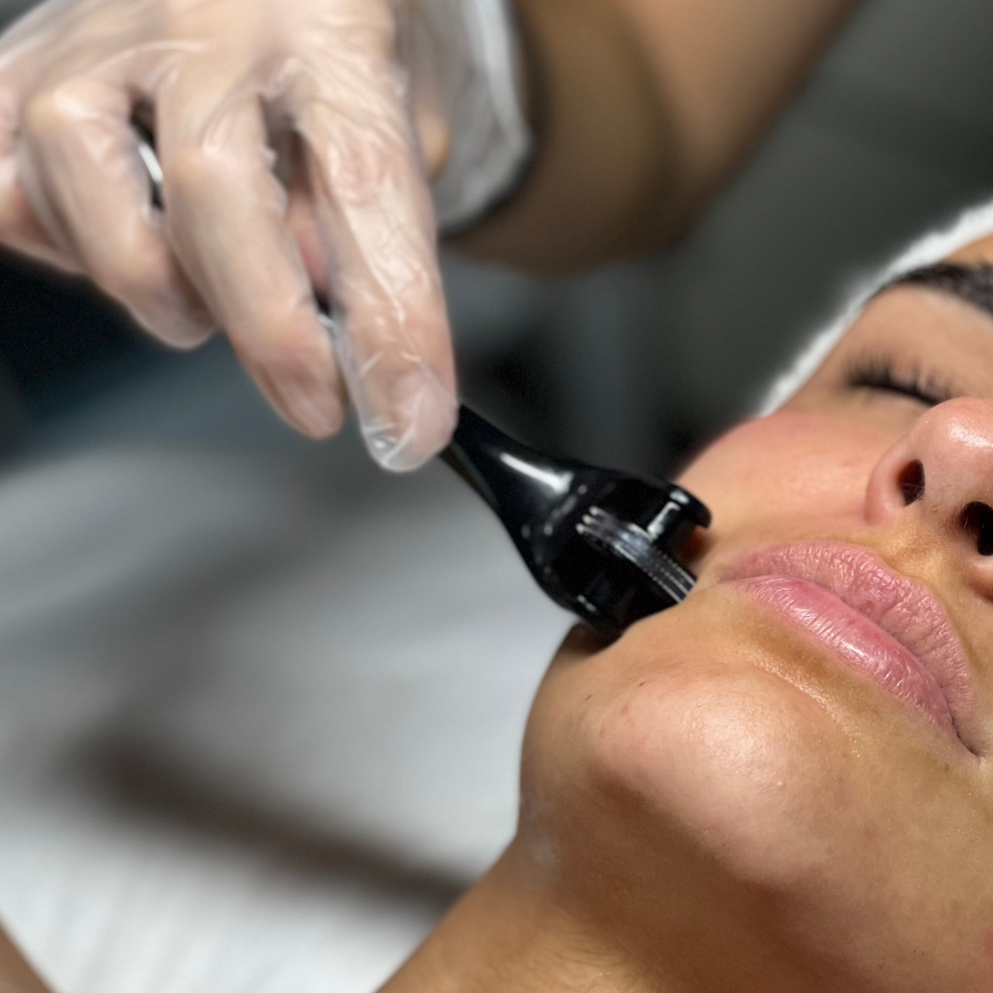 Dermaplaning + micro infusión de vitaminas con roller