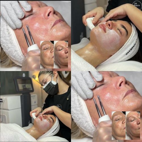 COMBO! Radiofrecuencia + Biolifting