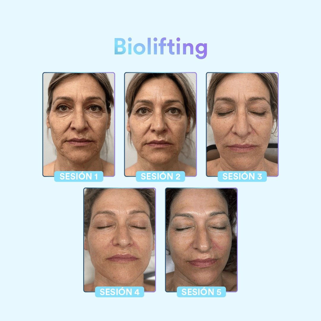 BONO ! Toskani Biolifting 4 sesiones a -50%