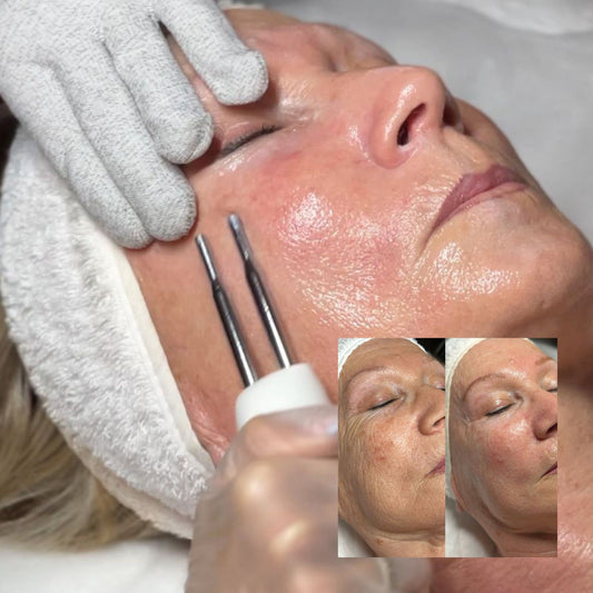 BONO ! Toskani Biolifting 4 sesiones a -50%